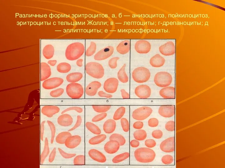 Различные формы эритроцитов. а, б — анизоцитоз, пойкилоцитоз, эритроциты с тельцами Жолли; в