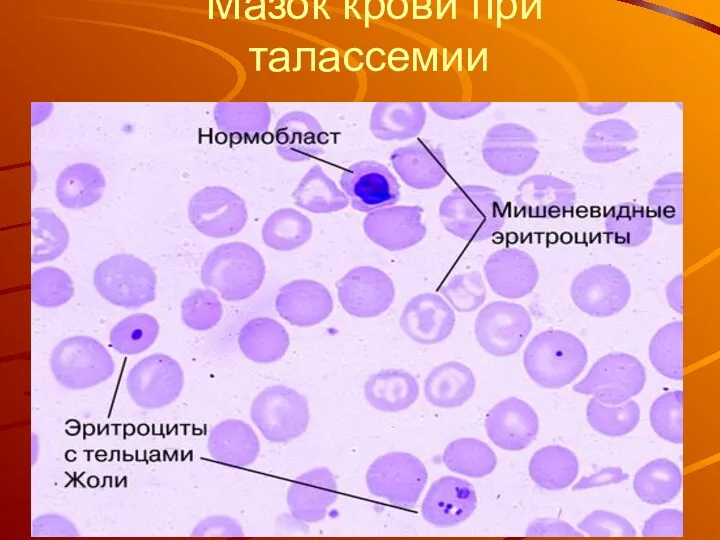 Мазок крови при талассемии