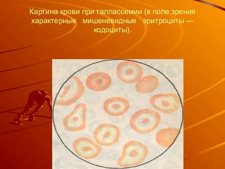 Картина крови при таллассемии (в поле зрения характерные мишеневидные эритроциты — кодоциты).