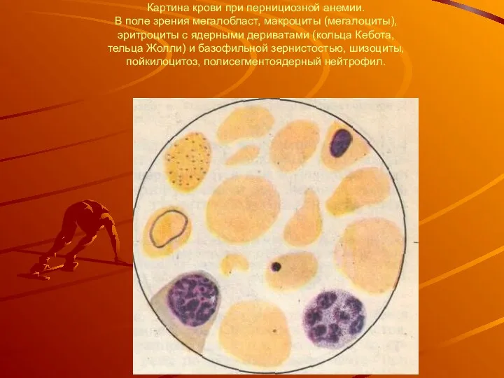 Картина крови при пернициозной анемии. В поле зрения мегалобласт, макроциты (мегалоциты), эритроциты с