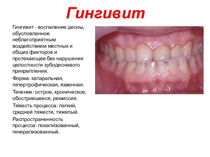 Гингивит Гингивит - воспаление десны, обусловленное неблагоприятным воздействием местных и