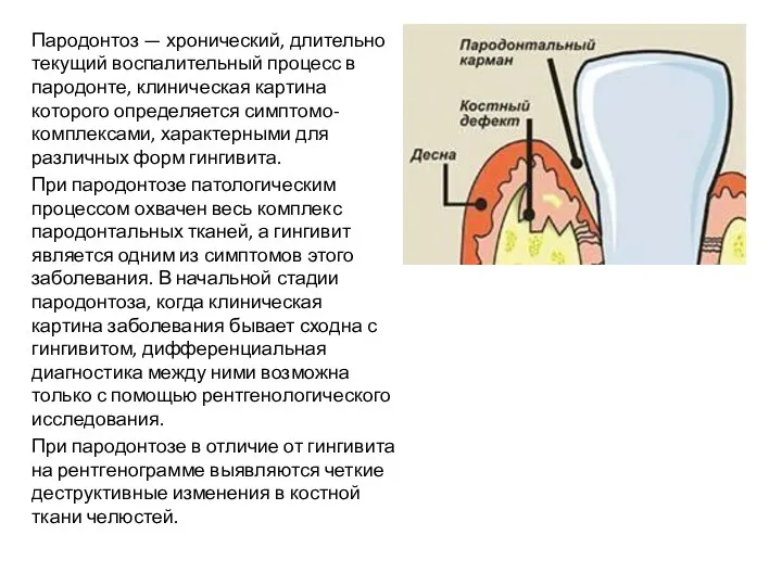 Пародонтоз — хронический, длительно текущий воспалительный процесс в пародонте, клиническая