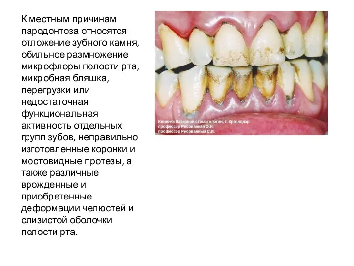 К местным причинам пародонтоза относятся отложение зубного камня, обильное размножение