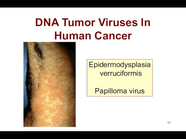 DNA Tumor Viruses In Human Cancer Epidermodysplasia verruciformis Papilloma virus