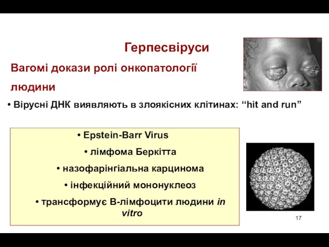 Герпесвіруси Вагомі докази ролі онкопатології людини Вірусні ДНК виявляють в злоякісних клітинах: “hit