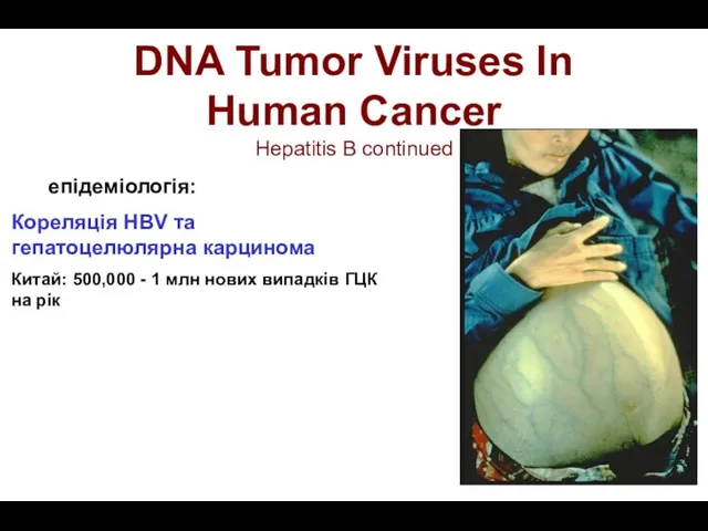 DNA Tumor Viruses In Human Cancer Hepatitis B continued епідеміологія: Кореляція HBV та