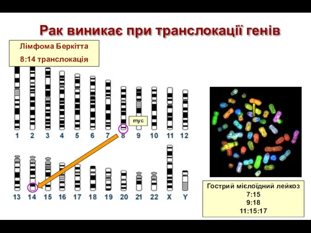 Рак виникає при транслокації генів Лімфома Беркітта 8:14 транслокація Гострий мієлоїдний лейкоз 7:15 9:18 11:15:17 myc