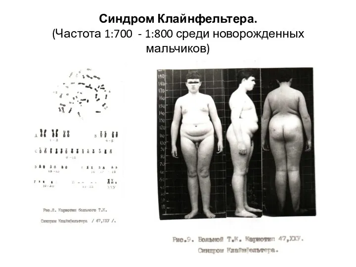 Синдром Клайнфельтера. (Частота 1:700 - 1:800 среди новорожденных мальчиков)