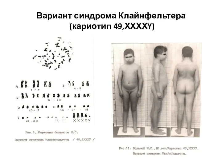 Вариант синдрома Клайнфельтера (кариотип 49,ХХХХY)