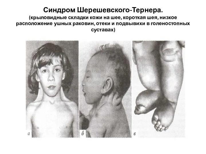 Синдром Шерешевского-Тернера. (крыловидные складки кожи на шее, короткая шея, низкое