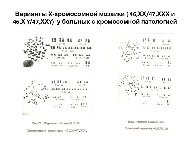 Варианты Х-хромосомной мозаики ( 46,ХХ/47,ХХХ и 46,Х Y/47,ХХY) у больных с хромосомной патологией
