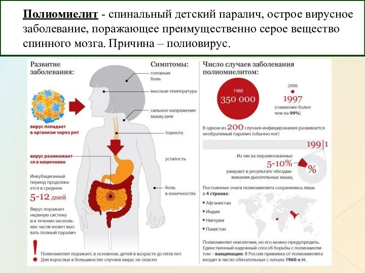 Полиомиелит - спинальный детский паралич, острое вирусное заболевание, поражающее преимущественно серое вещество спинного