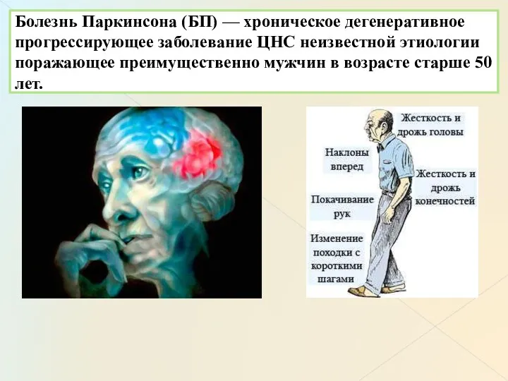 Болезнь Паркинсона (БП) — хроническое дегенеративное прогрессирующее заболевание ЦНС неизвестной этиологии поражающее преимущественно