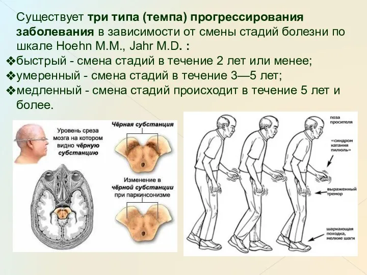 Существует три типа (темпа) прогрессирования заболевания в зависимости от смены