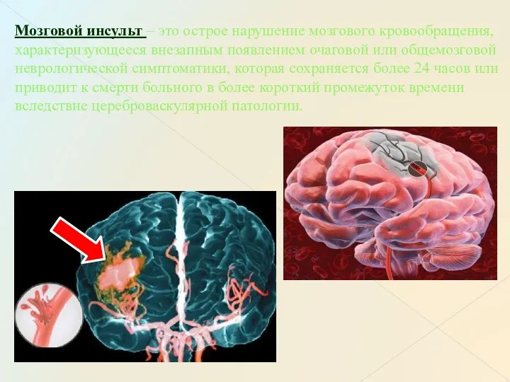 Мозговой инсульт – это острое нарушение мозгового кровообращения, характеризующееся внезапным появлением очаговой или