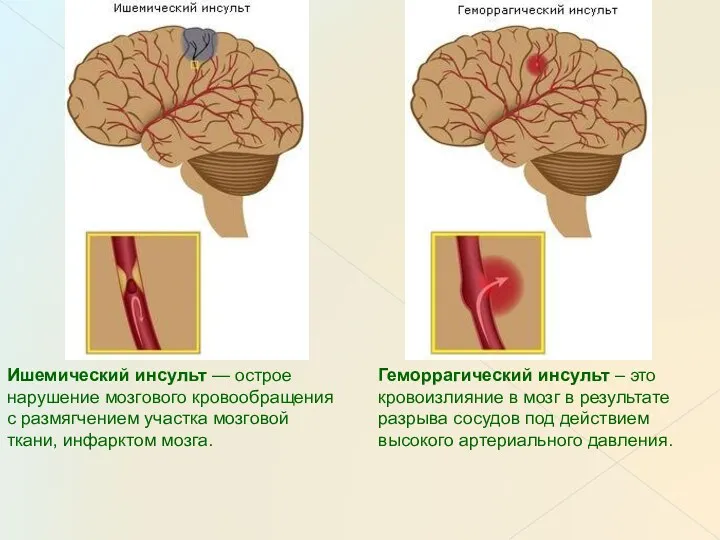 Ишемический инсульт — острое нарушение мозгового кровообращения с размягчением участка