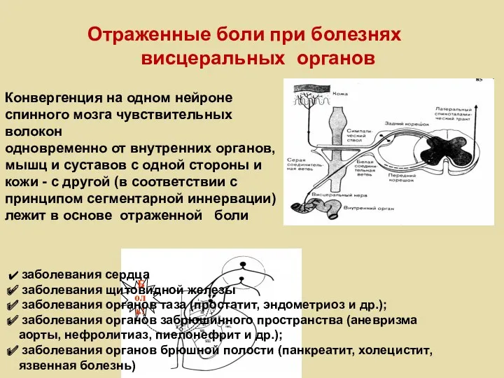 Отраженные боли при болезнях висцеральных органов Боль! Конвергенция на одном нейроне спинного мозга