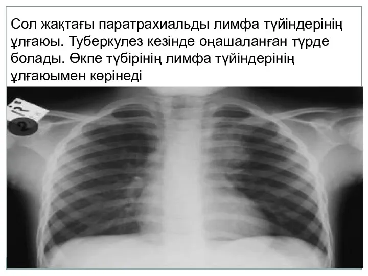 Сол жақтағы паратрахиальды лимфа түйіндерінің ұлғаюы. Туберкулез кезінде оңашаланған түрде