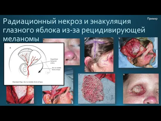 Радиационный некроз и энакуляция глазного яблока из-за рецидивирующей меланомы Пример