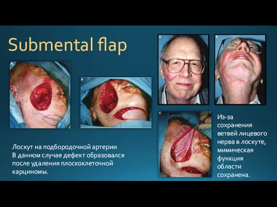 Submental flap Лоскут на подбородочной артерии В данном случае дефект