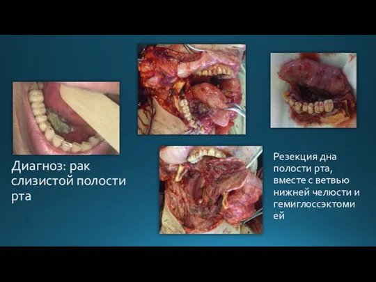 Диагноз: рак слизистой полости рта Резекция дна полости рта, вместе с ветвью нижней челюсти и гемиглоссэктомией