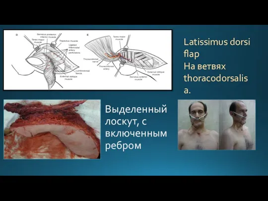 Выделенный лоскут, с включенным ребром Latissimus dorsi flap На ветвях thoracodorsalis a.