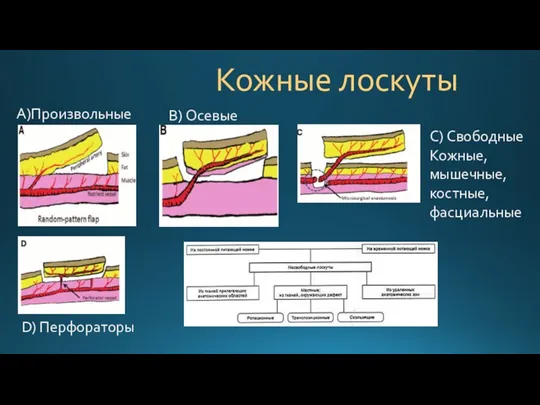 Кожные лоскуты А)Произвольные C) Свободные Кожные, мышечные, костные, фасциальные B) Осевые D) Перфораторы