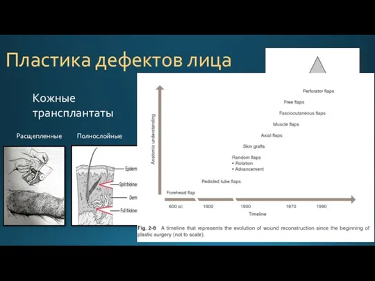 Пластика дефектов лица Кожные трансплантаты Расщепленные Полнослойные Реконструктивная лестница, от