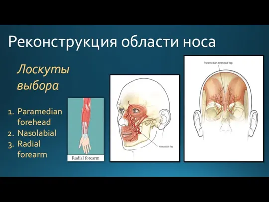 Реконструкция области носа Paramedian forehead Nasolabial Radial forearm Лоскуты выбора