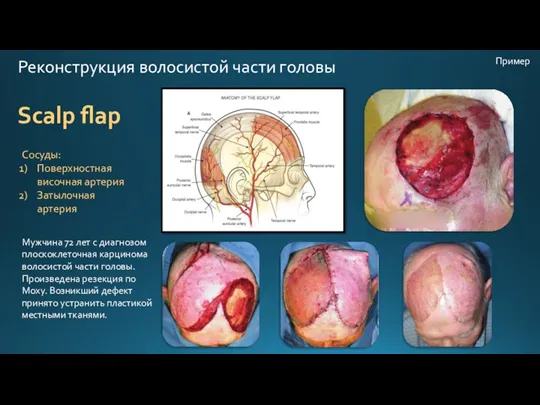 Реконструкция волосистой части головы Scalp flap Мужчина 72 лет с