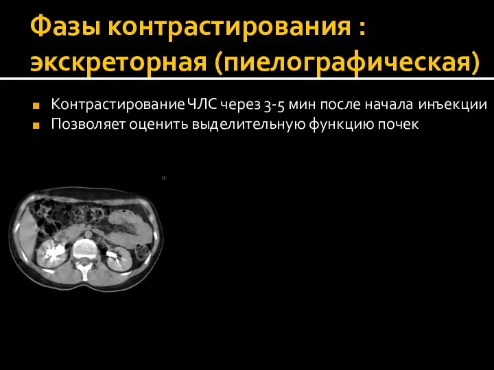 Фазы контрастирования : экскреторная (пиелографическая) Контрастирование ЧЛС через 3-5 мин