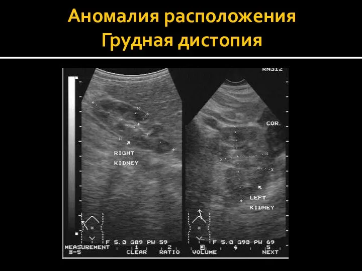 Аномалия расположения Грудная дистопия