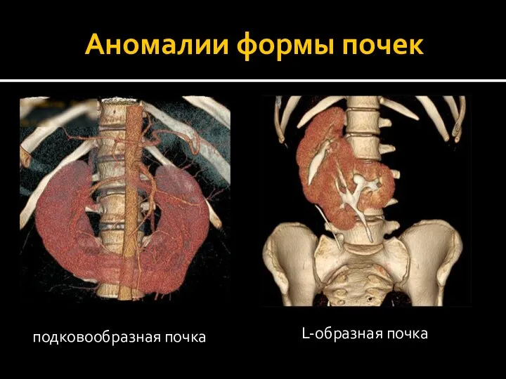 подковообразная почка L-образная почка Аномалии формы почек