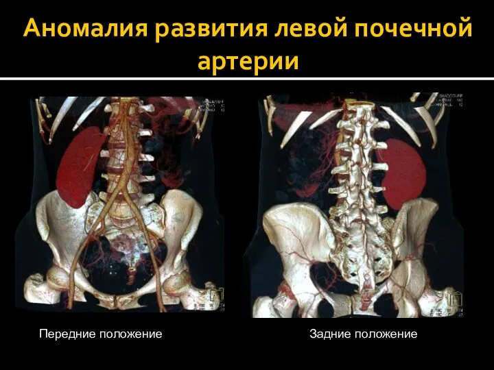 Аномалия развития левой почечной артерии Передние положение Задние положение
