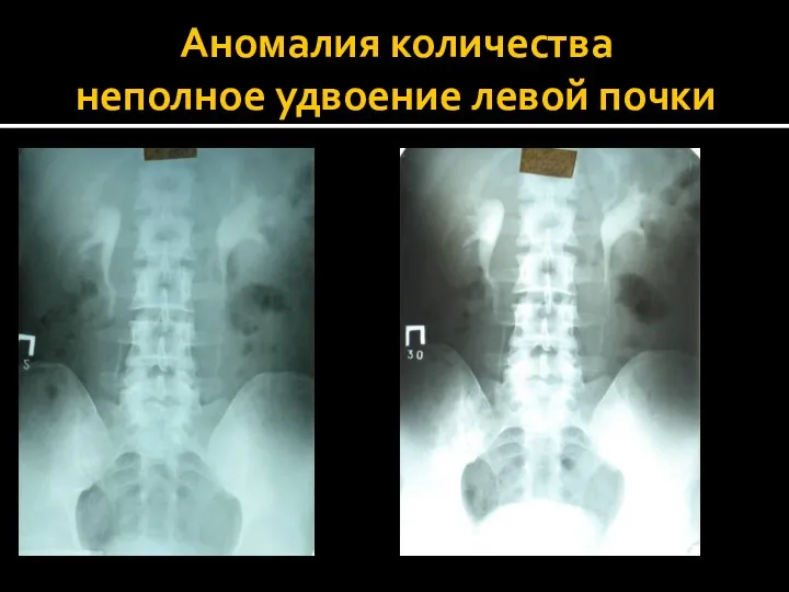 Аномалия количества неполное удвоение левой почки