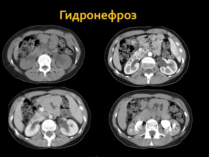 Гидронефроз