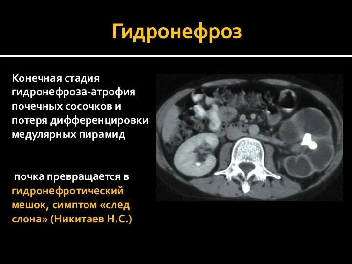 Гидронефроз Конечная стадия гидронефроза-атрофия почечных сосочков и потеря дифференцировки медулярных