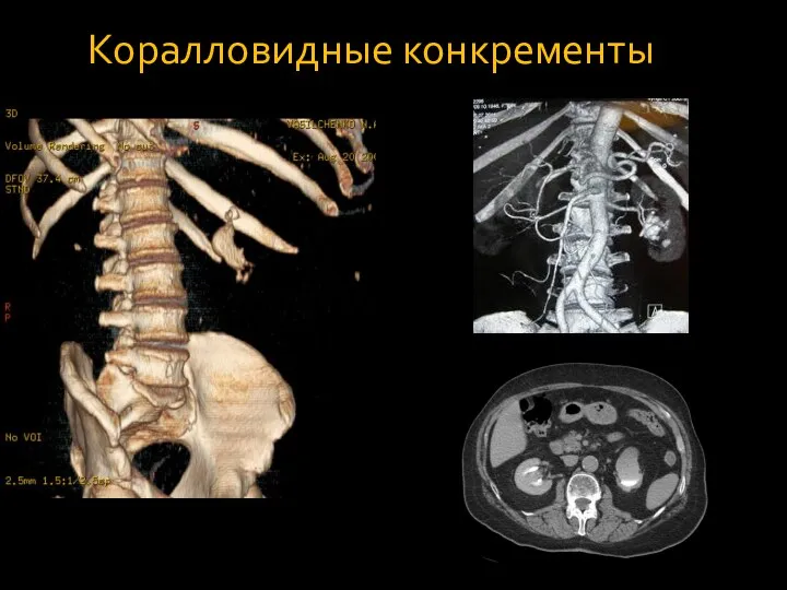 Коралловидные конкременты