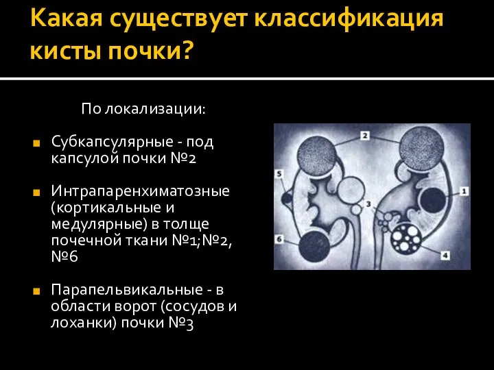 Какая существует классификация кисты почки? По локализации: Субкапсулярные - под