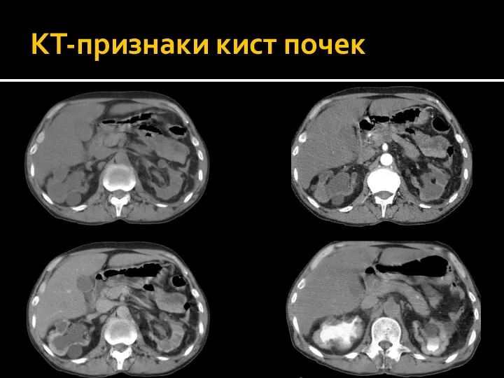 КТ-признаки кист почек