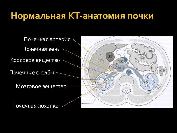 Нормальная КТ-анатомия почки Почечная артерия Почечная вена Корковое вещество Почечные столбы Мозговое вещество Почечная лоханка
