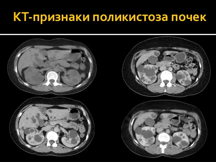 КТ-признаки поликистоза почек