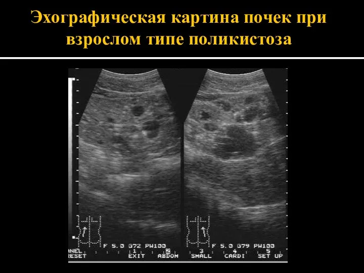 Эхографическая картина почек при взрослом типе поликистоза