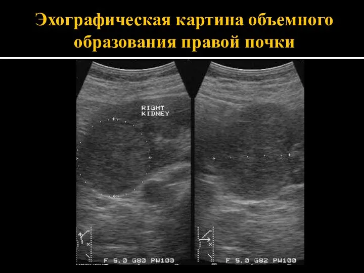 Эхографическая картина объемного образования правой почки