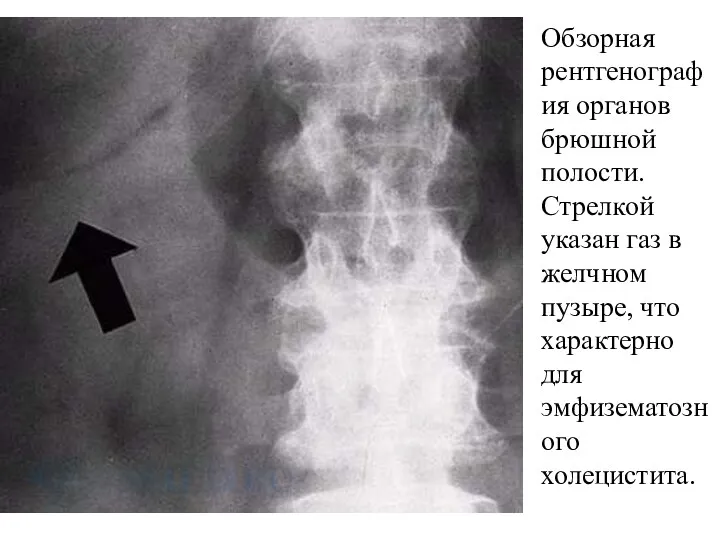 Обзорная рентгенография органов брюшной полости. Стрелкой указан газ в желчном пузыре, что характерно для эмфизематозного холецистита.