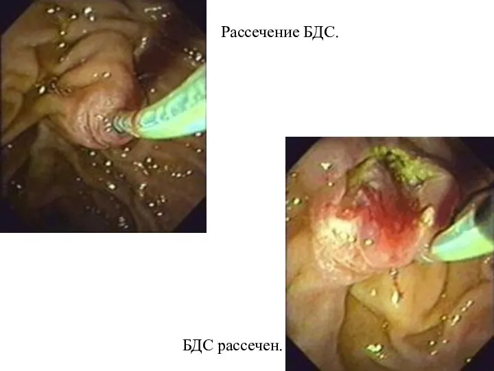 Рассечение БДС. БДС рассечен.