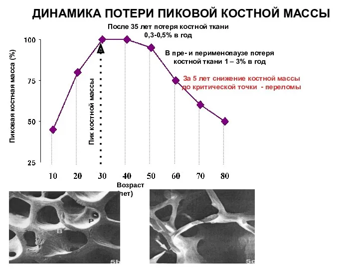 ДИНАМИКА ПОТЕРИ ПИКОВОЙ КОСТНОЙ МАССЫ