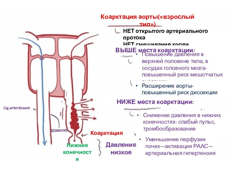 Lig.arteriosum Нижние конечности Коарктация Давление низкое Коарктация аорты(«взрослый тип») НЕТ