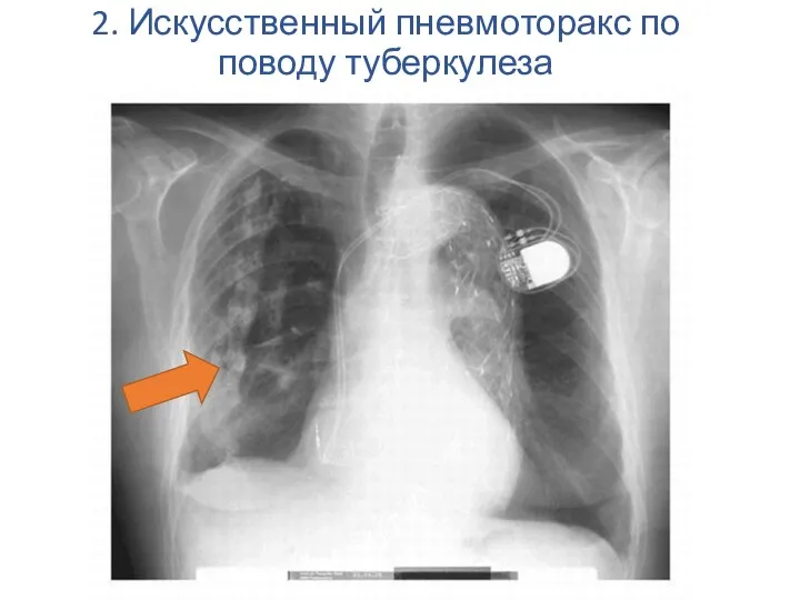 2. Искусственный пневмоторакс по поводу туберкулеза
