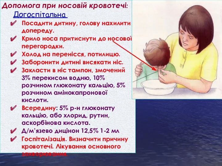 Допомога при носовій кровотечі: Догоспітальна : Посадити дитину, голову нахилити